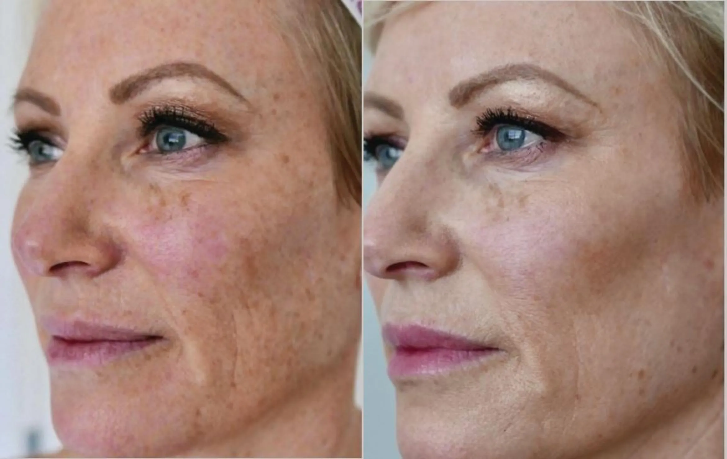 HALO Laser Skin Resurfacing Consultation with Doctor