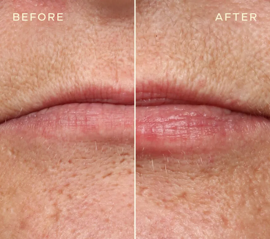 Lip Filler Refill