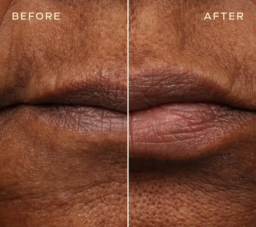 Lip Filler Refill